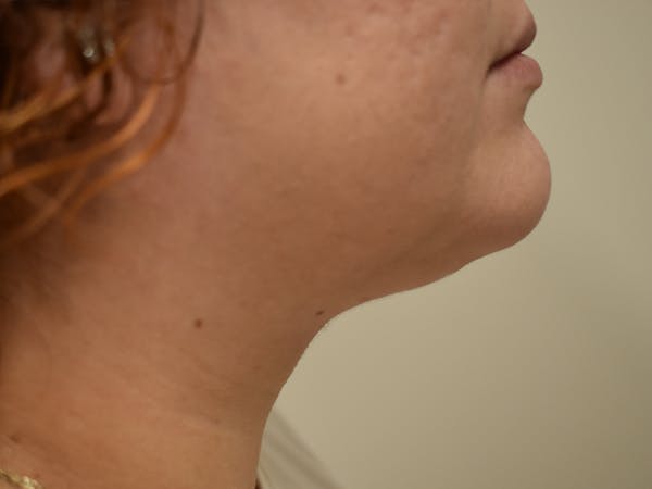 Submental Liposuction Before & After Gallery - Patient 327492 - Image 2