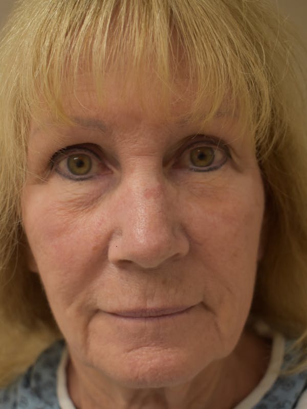 Co2 Laser Resurfacing Before & After Gallery - Patient 345155 - Image 1