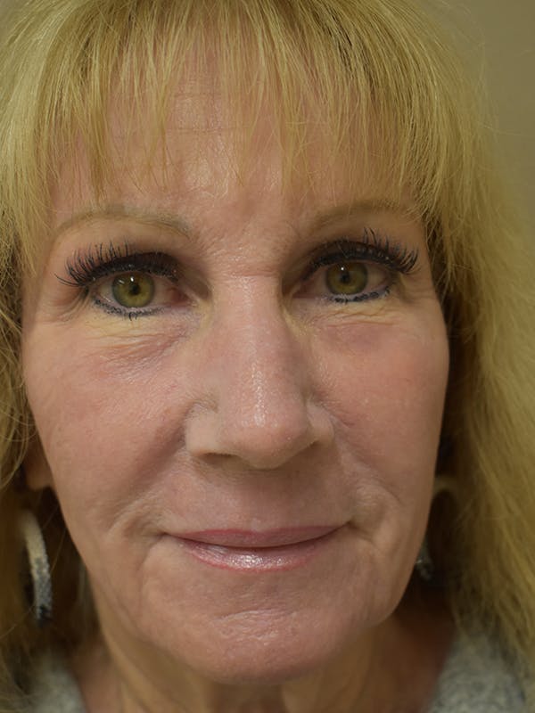 Co2 Laser Resurfacing Before & After Gallery - Patient 345155 - Image 2