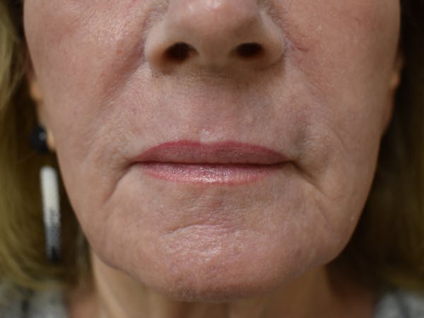 Co2 Laser Resurfacing Before & After Gallery - Patient 345155 - Image 6
