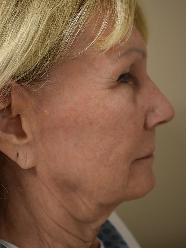 Co2 Laser Resurfacing Before & After Gallery - Patient 345155 - Image 4
