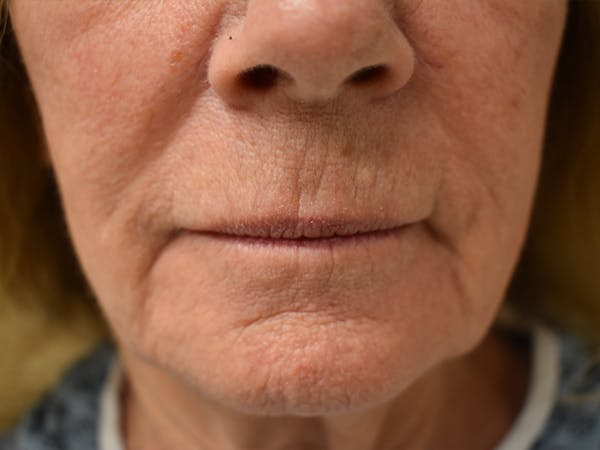 Co2 Laser Resurfacing Before & After Gallery - Patient 345155 - Image 5