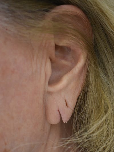 Otoplasty Before & After Gallery - Patient 119976 - Image 1