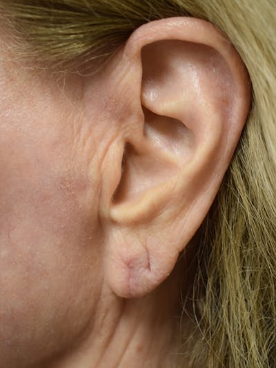 Otoplasty Before & After Gallery - Patient 119976 - Image 2