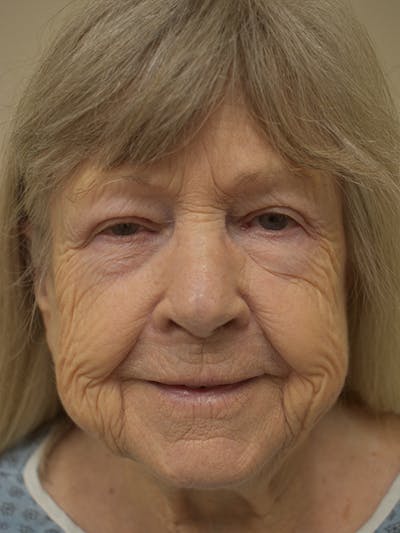 Nasolabial Fold Before & After Gallery - Patient 175690 - Image 1