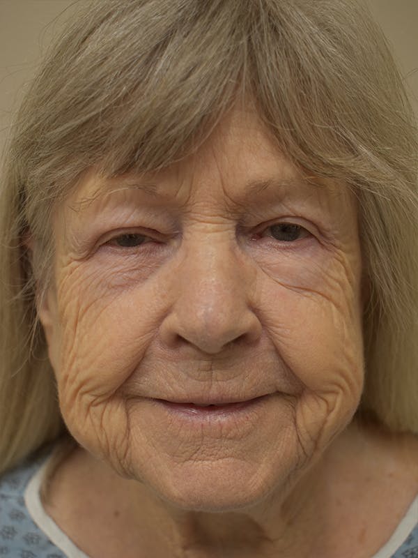 Nasolabial Fold Before & After Gallery - Patient 175690 - Image 1