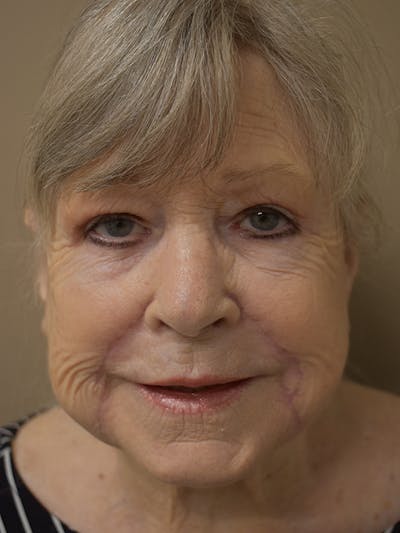 Nasolabial Fold Before & After Gallery - Patient 175690 - Image 2