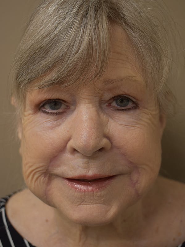 Nasolabial Fold Before & After Gallery - Patient 175690 - Image 2