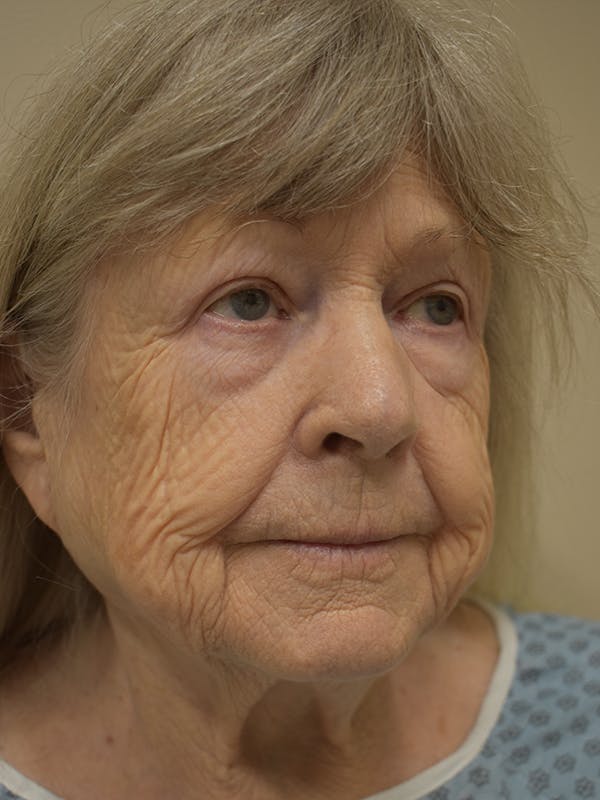 Nasolabial Fold Before & After Gallery - Patient 175690 - Image 3