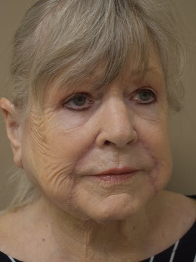 Nasolabial Fold Before & After Gallery - Patient 175690 - Image 4