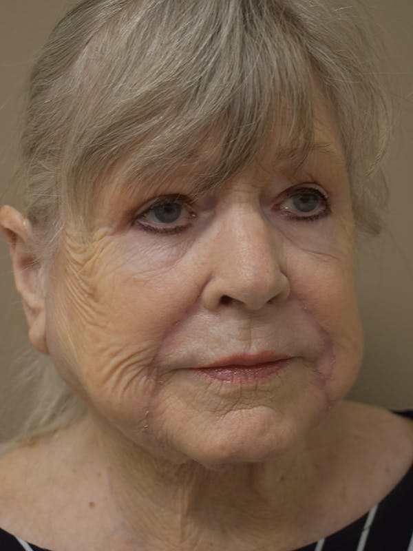 Nasolabial Fold Before & After Gallery - Patient 175690 - Image 4