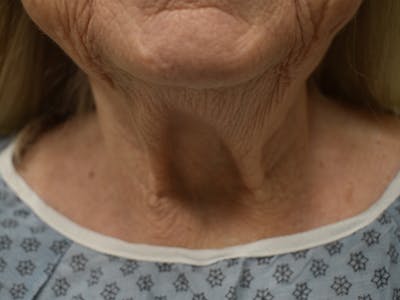 Nasolabial Fold Before & After Gallery - Patient 175690 - Image 6