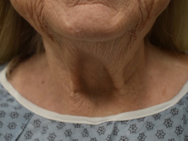 Nasolabial Fold Before & After Gallery - Patient 175690 - Image 6