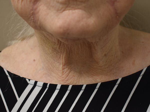 Nasolabial Fold Before & After Gallery - Patient 175690 - Image 5