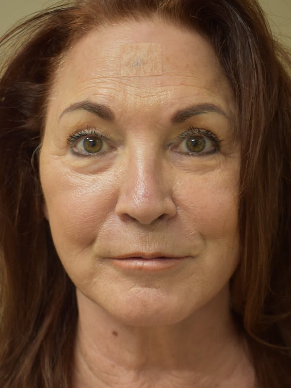 Facelift Before & After Gallery - Patient 419467 - Image 2