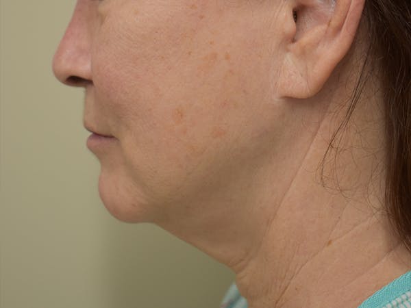 Facelift Before & After Gallery - Patient 419467 - Image 5