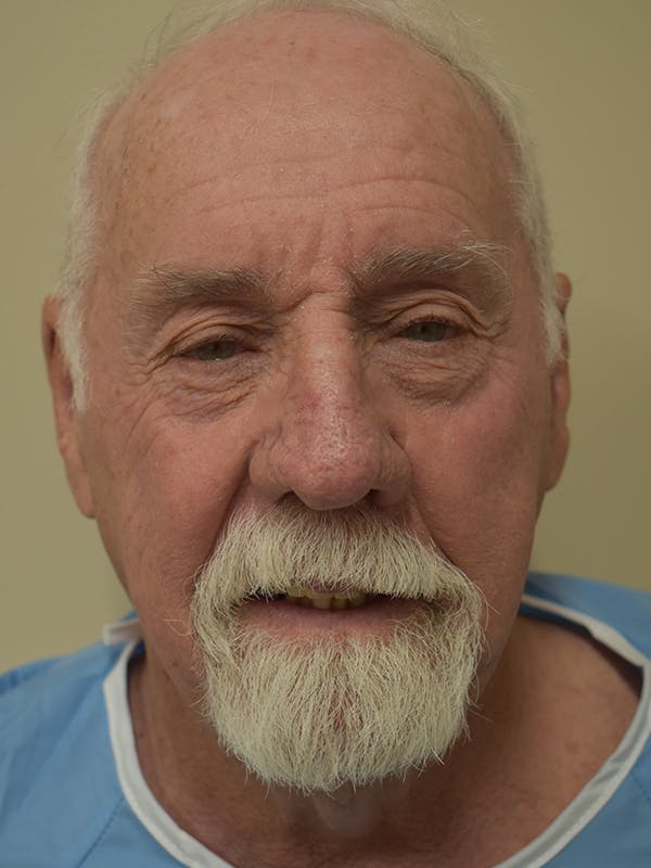 Facelift Before & After Gallery - Patient 230984 - Image 1