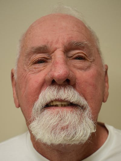 Facelift Before & After Gallery - Patient 230984 - Image 2