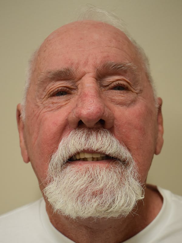Facelift Before & After Gallery - Patient 230984 - Image 2