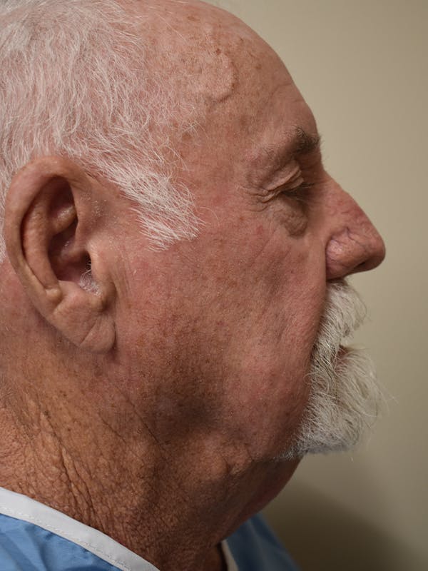 Facelift Before & After Gallery - Patient 230984 - Image 3