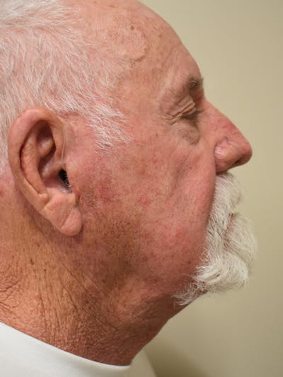 Facelift Before & After Gallery - Patient 230984 - Image 4