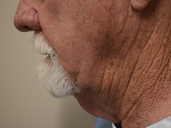 Facelift Before & After Gallery - Patient 230984 - Image 5