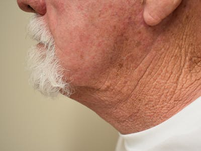 Facelift Before & After Gallery - Patient 230984 - Image 6