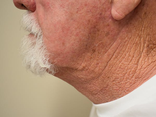 Facelift Before & After Gallery - Patient 230984 - Image 6