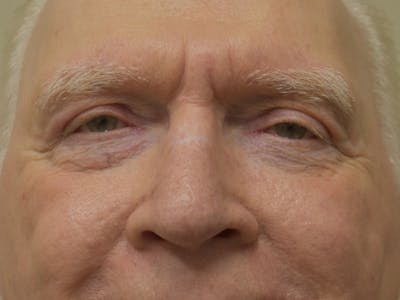 Eyelid Surgery Before & After Gallery - Patient 183355 - Image 2
