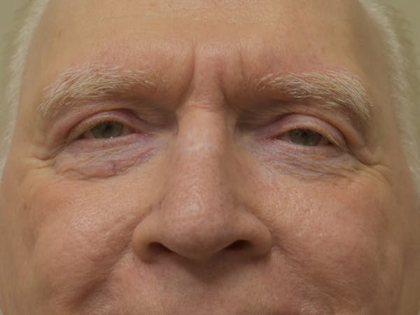 Eyelid Surgery Before & After Gallery - Patient 183355 - Image 2