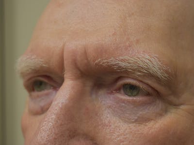Eyelid Surgery Before & After Gallery - Patient 183355 - Image 4