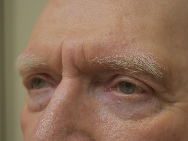 Eyelid Surgery Before & After Gallery - Patient 183355 - Image 4