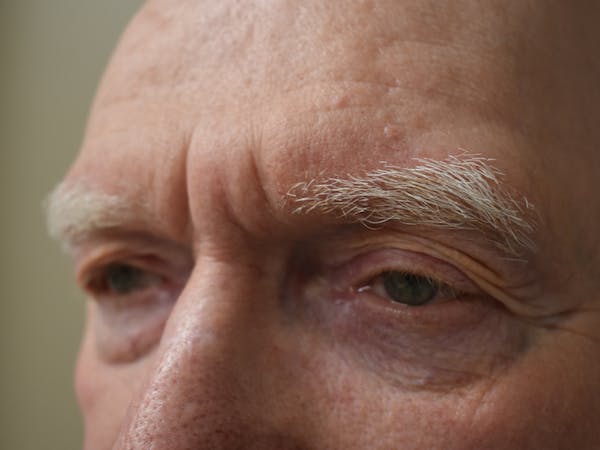 Eyelid Surgery Before & After Gallery - Patient 183355 - Image 3