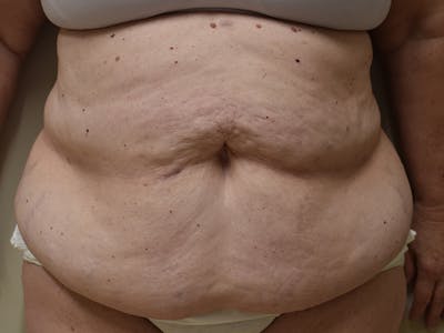Tummy Tuck Before & After Gallery - Patient 271273 - Image 1