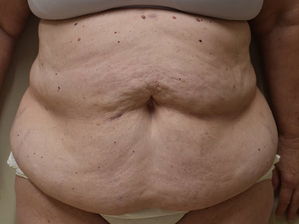 Tummy Tuck Before & After Gallery - Patient 271273 - Image 1