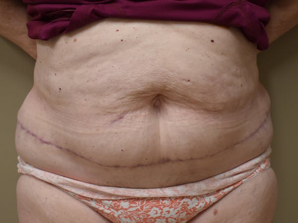 Tummy Tuck Before & After Gallery - Patient 271273 - Image 2