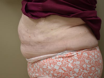 Tummy Tuck Before & After Gallery - Patient 271273 - Image 6
