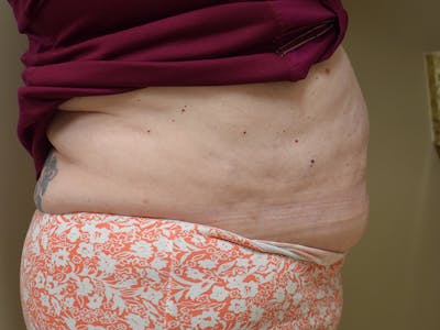Tummy Tuck Before & After Gallery - Patient 271273 - Image 4