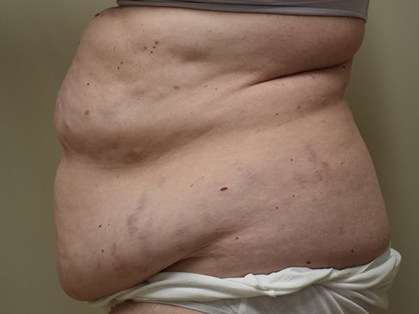 Tummy Tuck Before & After Gallery - Patient 271273 - Image 5
