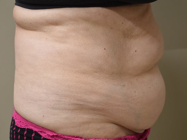 Tummy Tuck Before & After Gallery - Patient 140939 - Image 5