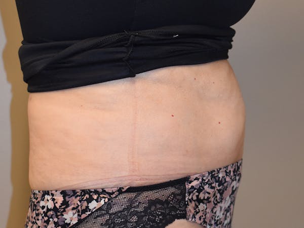 Tummy Tuck Before & After Gallery - Patient 140939 - Image 6