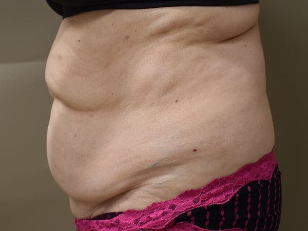 Tummy Tuck Before & After Gallery - Patient 140939 - Image 7