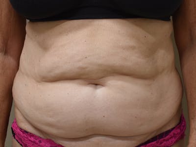 Tummy Tuck Before & After Gallery - Patient 140939 - Image 1