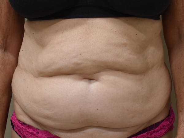 Tummy Tuck Before & After Gallery - Patient 140939 - Image 1