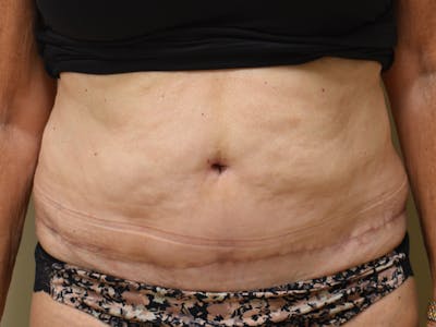 Tummy Tuck Before & After Gallery - Patient 140939 - Image 2