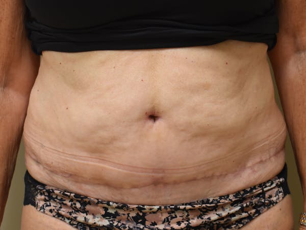 Tummy Tuck Before & After Gallery - Patient 140939 - Image 2