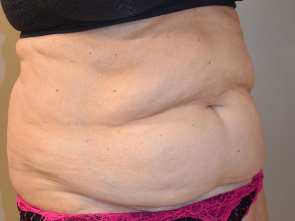 Tummy Tuck Before & After Gallery - Patient 140939 - Image 3