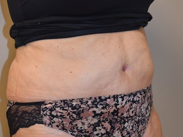 Tummy Tuck Before & After Gallery - Patient 140939 - Image 4