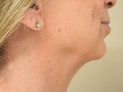 Chin Augmentation Before & After Gallery - Patient 353498 - Image 6