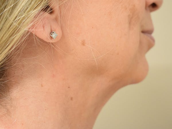 Chin Augmentation Before & After Gallery - Patient 353498 - Image 6